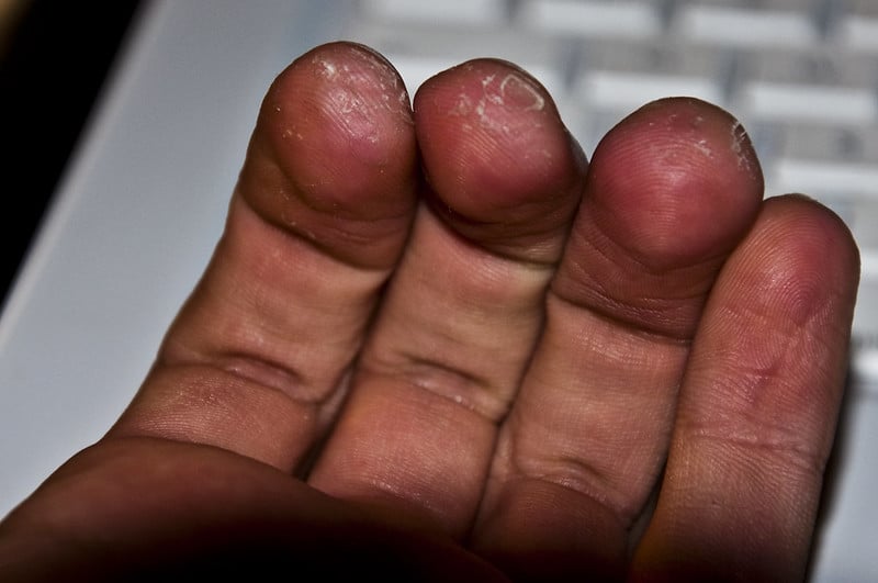 Finger Calluses